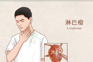 大腿淋巴癌早期症状，3个典型表现会提示你