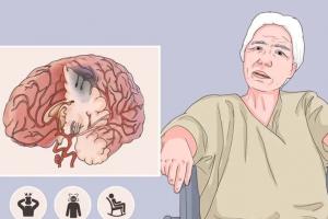 中风的九个前兆症状，家里有老人的一定要知道
