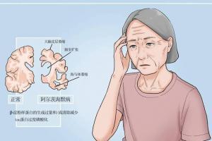 盘点老年痴呆最初表现，老年朋友需要多留意