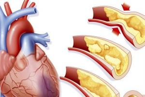 心肌梗塞是什么原因引起的？这5大原因值得反省一下