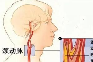 颈动脉血管斑块怎么治疗？联合3个方法消除颈动脉斑块