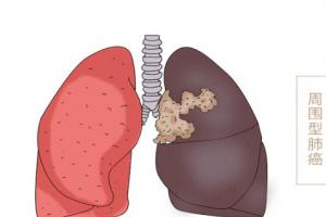 肺癌晚上睡觉的4个征兆，肺癌发出的求救信号你知道吗