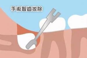 女士拔智齿的最佳时间，怎么判断智齿要不要拔?