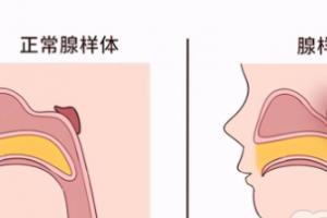 腺样体肥大是什么症状？腺样体肥大要怎么办？