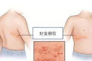 疱疹能彻底治好吗？疱疹要如何预防？