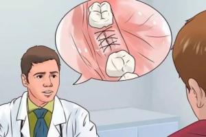 拔牙后有哪些注意事项?拔牙后要注意以下8点