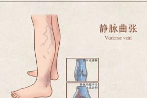 下肢静脉曲张需要治疗吗？有哪些影响？