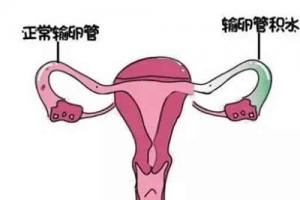 专家解析女性输卵管积水怎么做试管婴儿-建议先治疗