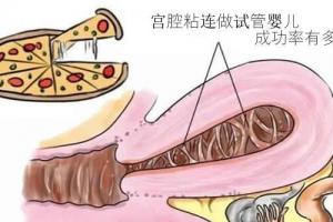 [专题科普]宫腔粘连做试管婴儿成功率有多少