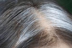 女人开始长白发意味着什么？长白发的原因有哪些？