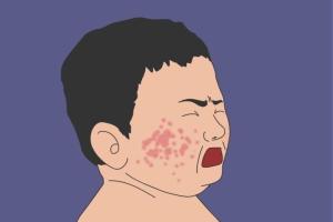 脂溢性皮炎的症状有哪些？得了脂溢性皮炎怎么办？