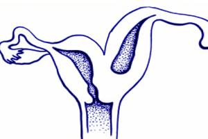 单角子宫可以做试管婴儿吗，助孕费用大约在5-9万元左右
