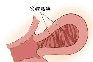 宫腔中度粘连做试管婴儿成功率高吗？治疗后受孕几率翻倍