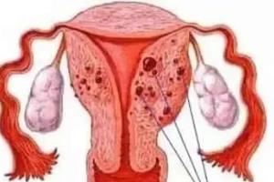 腺肌症患者子宫控制到多大可以正常移植囊胚？子宫空间决定胚胎存活率