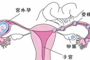 宫外怀孕初期症状有哪些？这7种情况出现就需要引起警惕