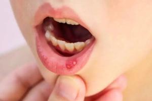 健康关注：口腔溃疡吃什么维生素?这四类水果一定要多吃！