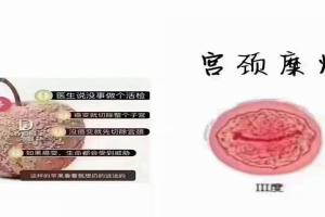 宫颈糜烂一二三度有什么区别，内附相关图片分享