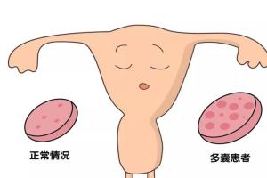 专题讨论：多囊卵巢综合征适合做第几代试管婴儿，成功率高吗