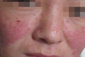 红斑狼疮患者可以做试管婴儿吗？这种技术可以筛除还能成功受孕