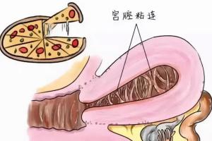 宫腔局部粘连会自愈吗？偷偷告诉你宫腔粘连三种保守治疗方法！