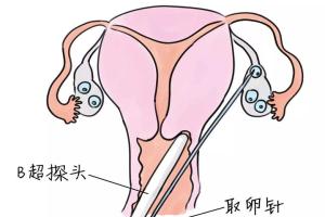 专家盘点：2022取卵手术全过程，最新技术及流程一览