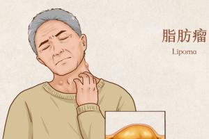 女子肚子变大以为是长胖一查是肿瘤！“定期体检”真的很重要
