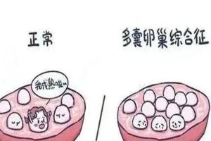 28岁多囊卵巢闭经患者适合人工授精还是试管婴儿？附费用预估与成功率