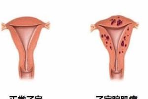 子宫腺肌症可以试管双胞胎吗？三个硬性条件缺一不可
