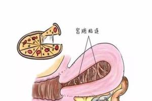 宫腔粘连的症状有哪些？“月经减少”就是危险信号