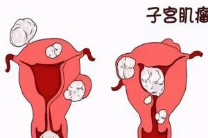 子宫肌瘤症状迅速自查，5大症状切勿拖延
