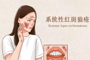 红斑狼疮早期症状图片分享，按图比对又快又准