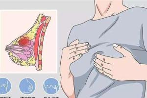 乳腺癌的早期症状和前兆？15大征兆快速比对准确