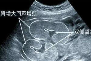 肾盂分离百分之99男孩？勿信谣言真假自辨