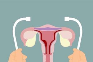 一文详解当女性患有子宫内膜异位症手术后能成功怀孕吗