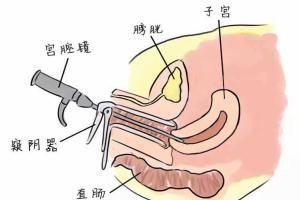 弓形子宫试管前有必要做宫腔镜检查吗？答案是肯定的