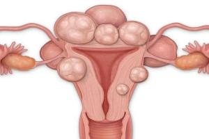 子宫肌瘤多大需要手术治疗？且看是否中了这5种严重的症状
