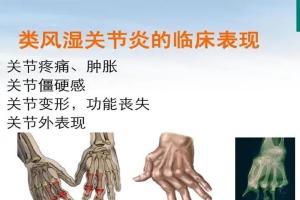 类风湿关节炎患者能做试管婴儿吗？建议先治疗