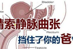 什么是精索静脉曲张