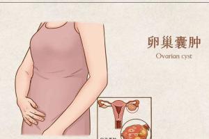 卵巢囊肿名词科普