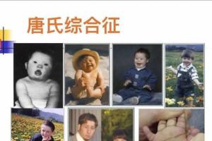 唐氏综合症的名词科普