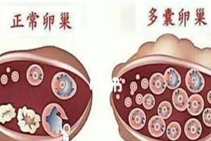 多囊卵巢名词科普