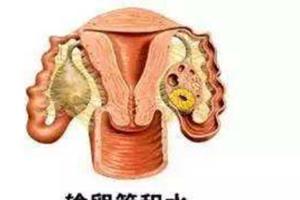 什么是输卵管积水？