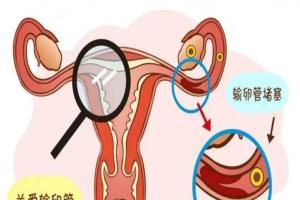 女性输卵管堵塞的原因和预防