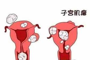 什么是子宫肌瘤和造成子宫肌瘤的原因