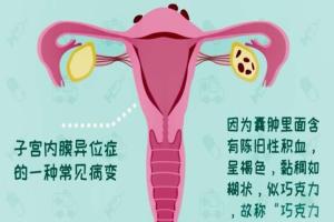 卵巢巧克力囊肿能直接做试管婴儿吗？因根据自身实际病况而定