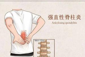 [答疑篇]强直性脊柱炎结婚后可以做试管吗？可以避免胎儿遗传这个病吗