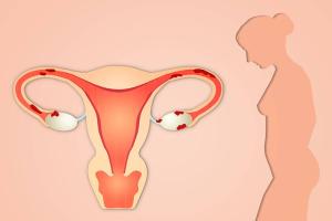 卵巢畸胎瘤能做试管吗?专家提醒尽早保留生育力