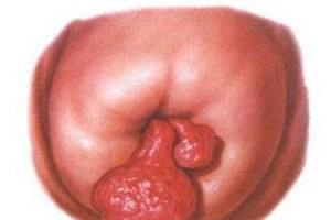 宫颈息肉能做试管婴儿吗？可以，但风险无法掌控