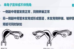 单角子宫畸形能做试管吗？具体情况具体分析
