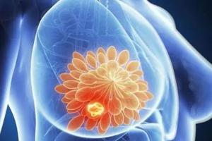 专家深度解析乳腺结节三类能做试管婴儿吗